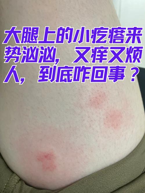 皮肤一挠就起疙瘩还痒是啥原因?