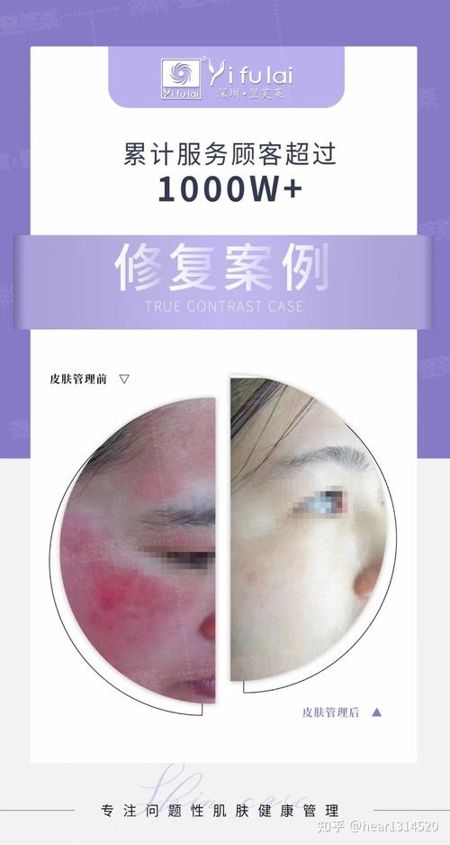 北京皮肤科祛斑哪家医院效果最好?