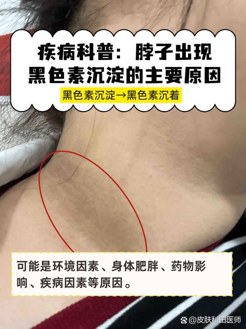 皮肤色素沉着,到底啥原因引起的?