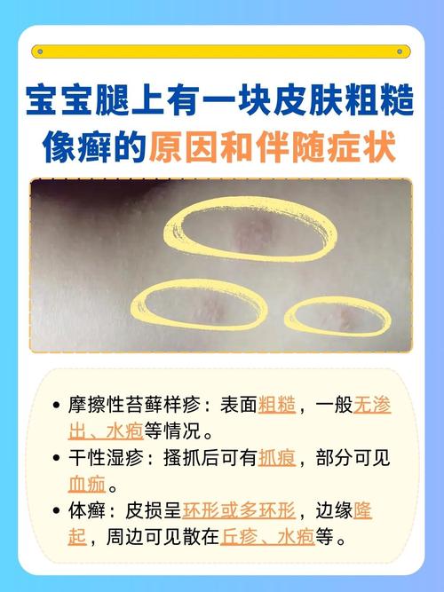 儿童皮肤病图片及名称大全,如何准确识别?