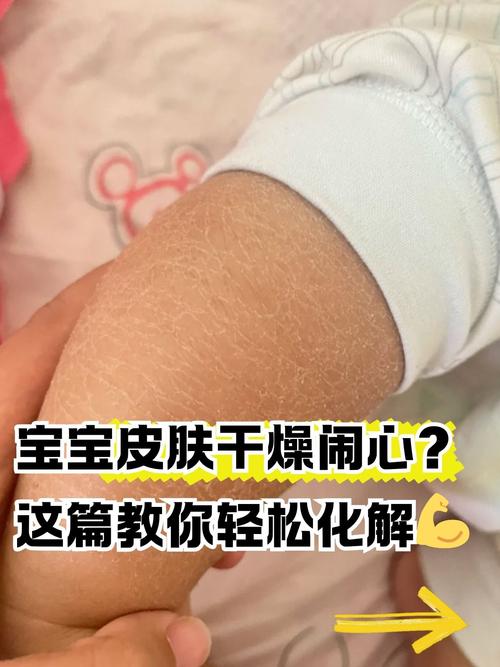 新生儿皮肤干燥脱皮是何原因?