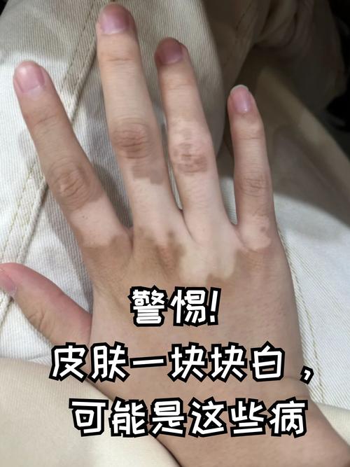 皮肤一块白一块白是啥原因?