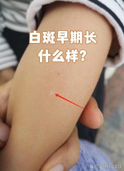 皮肤一块白一块白是啥原因?