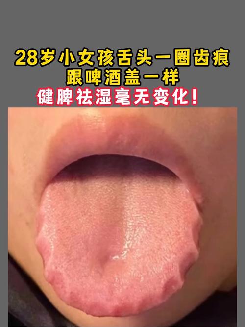 舌头有齿痕该吃啥食物调理?