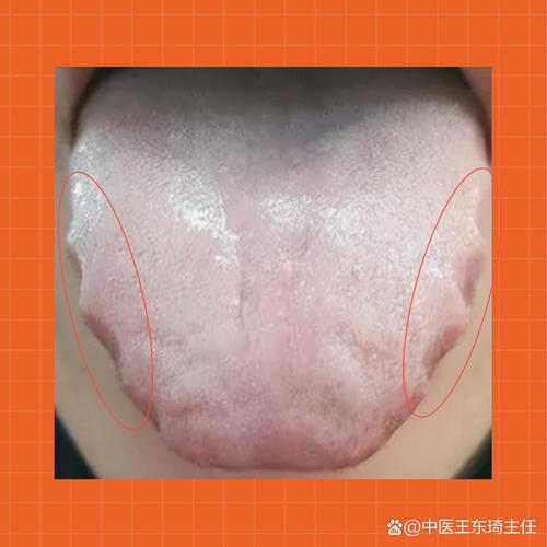 舌头有齿痕该吃啥食物调理?