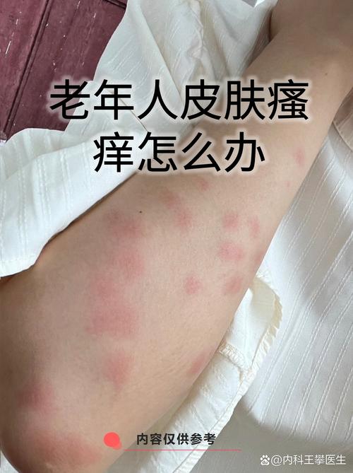 老年人皮肤瘙痒最常见原因是什么?