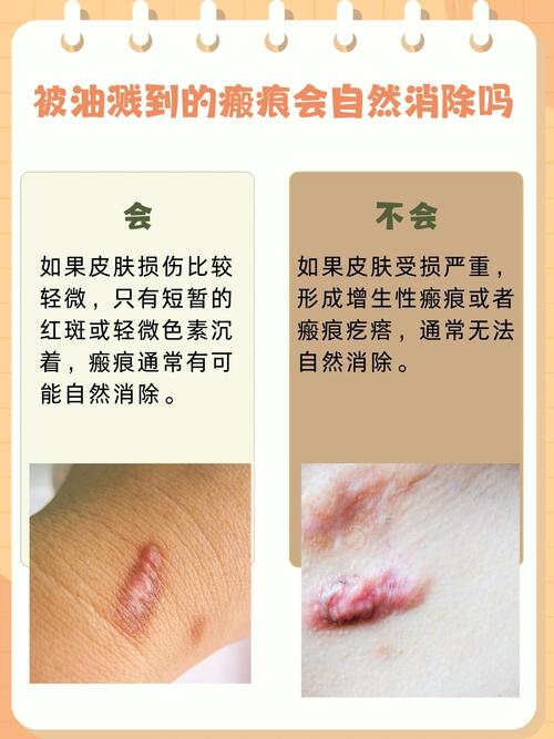 油溅到皮肤红了怎么办?