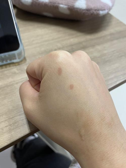 油溅到皮肤红了怎么办?