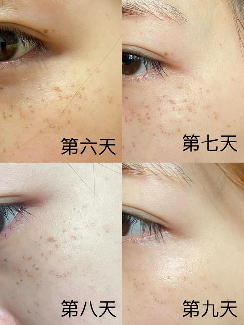 激光祛斑后多久能恢复如初?