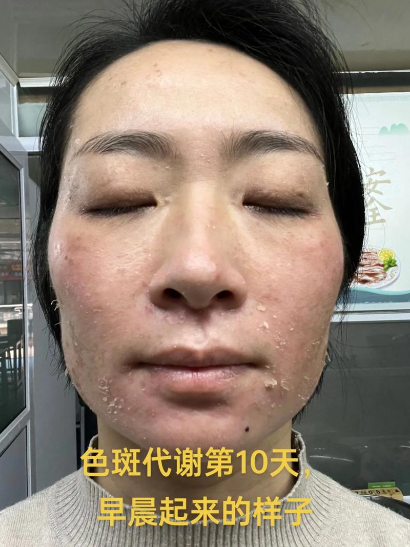 激光祛斑后多久能恢复如初?