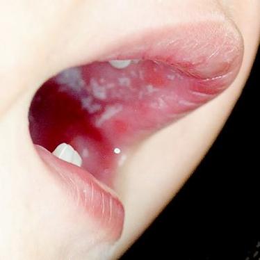 口腔内白色膜是何物?