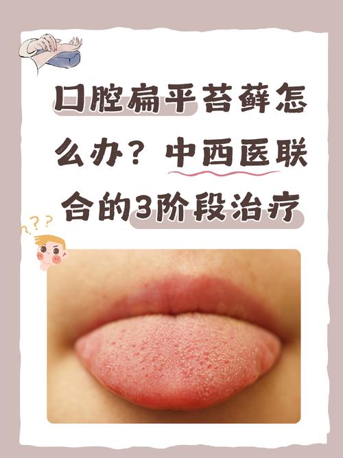 口腔粘膜白斑和扁平苔藓如何区分?