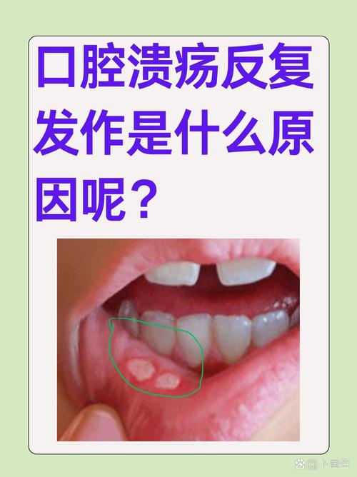 反复口腔溃疡是身体哪里出问题了吗?