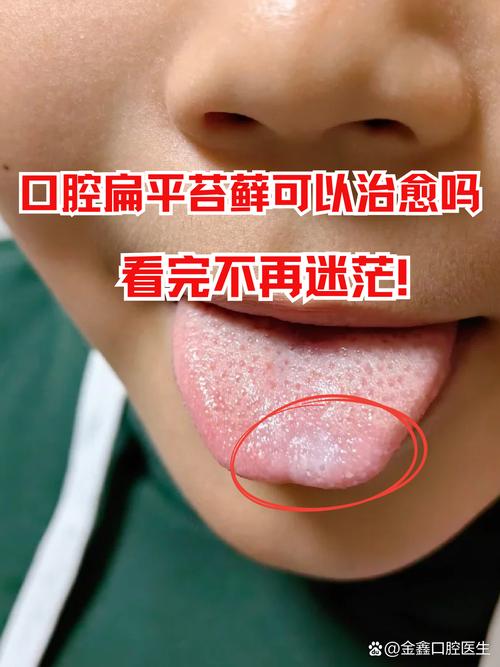 口腔扁平苔藓吃哪种食物能治好?