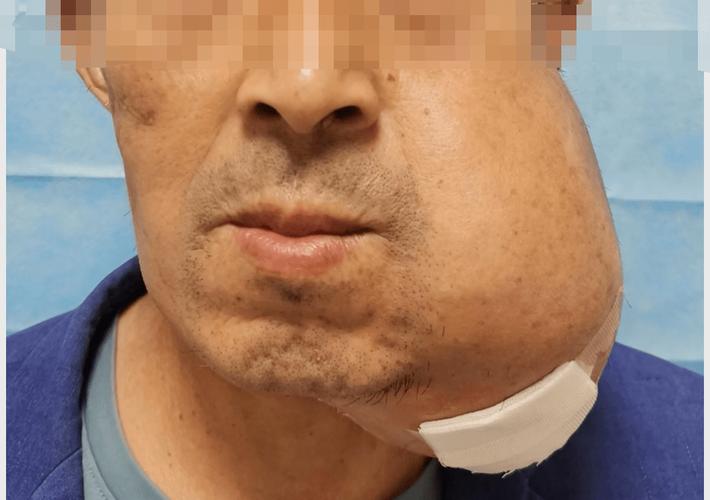 口腔颌面部肿瘤为何不易早期发现?