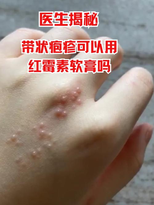 皮肤过敏能用红霉素软膏吗?