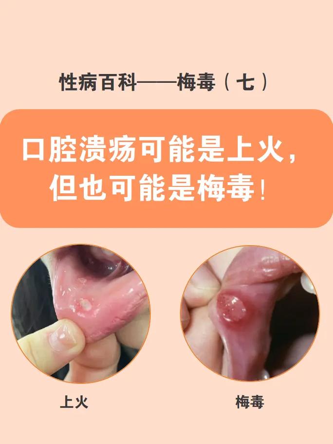 口腔溃疡快速好得快有什么妙招?