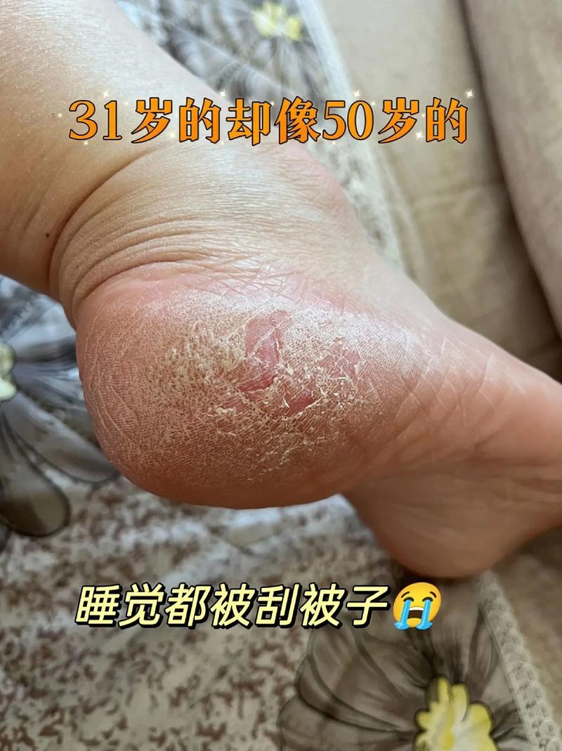 手脚皮肤干燥粗糙,是缺水还是生病了?