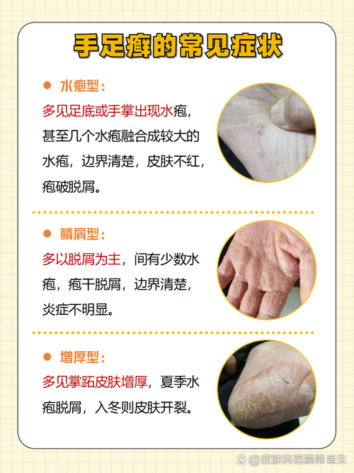 手脚皮肤干燥粗糙,是缺水还是生病了?