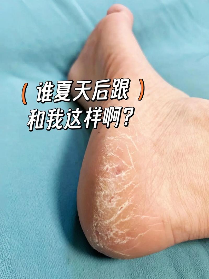 手脚皮肤干燥粗糙,是缺水还是生病了?