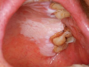 口腔粘膜白色硬斑是何病?