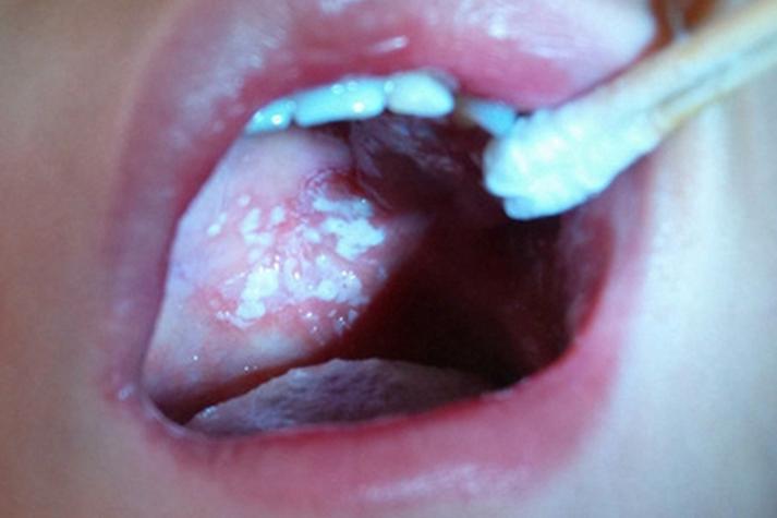 口腔粘膜白色硬斑是何病?