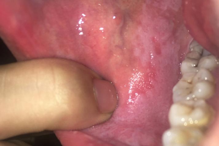 口腔粘膜白色硬斑是何病?