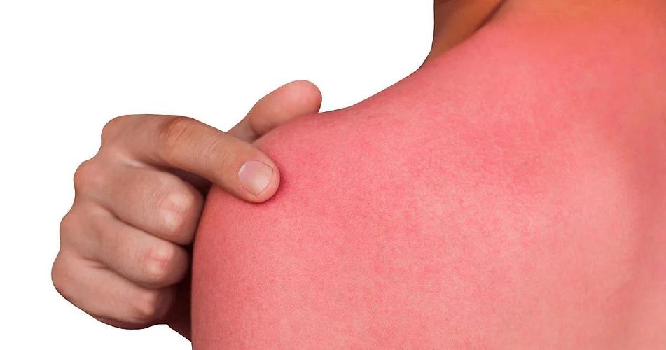 UVB与UVA,哪个对皮肤伤害更大?