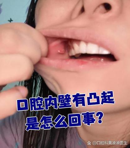 为何总咬到口腔内壁?