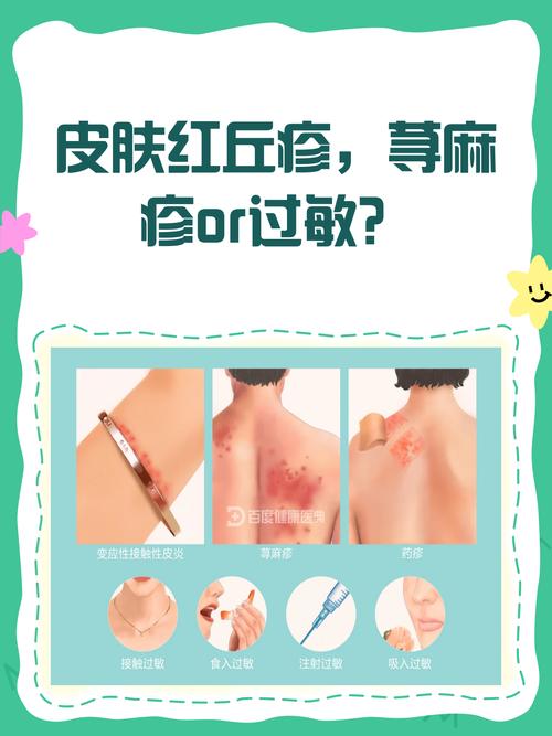 荨麻疹和皮肤过敏是一回事吗?