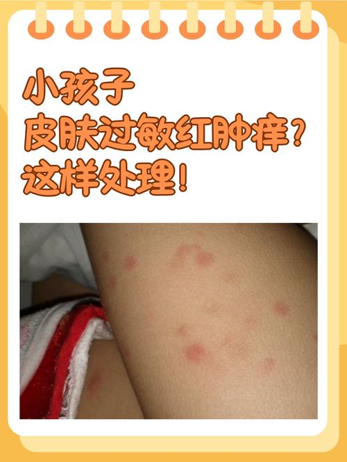 小孩皮肤过敏频发,根源究竟在何处?