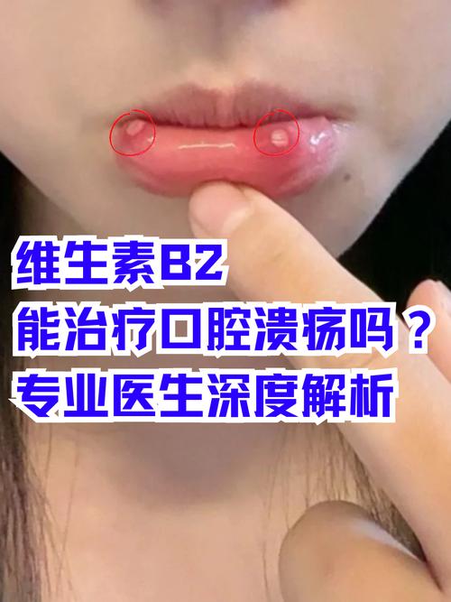 口腔溃疡吃维生素B2到底管不管用?