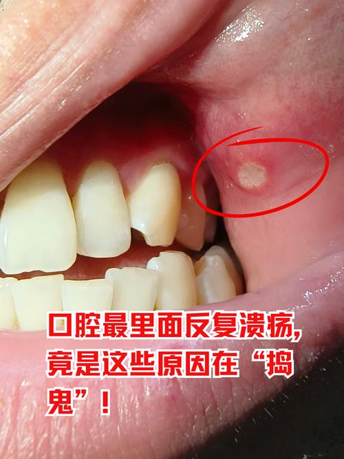 口腔溃疡反复发作,是身体发出的什么信号?