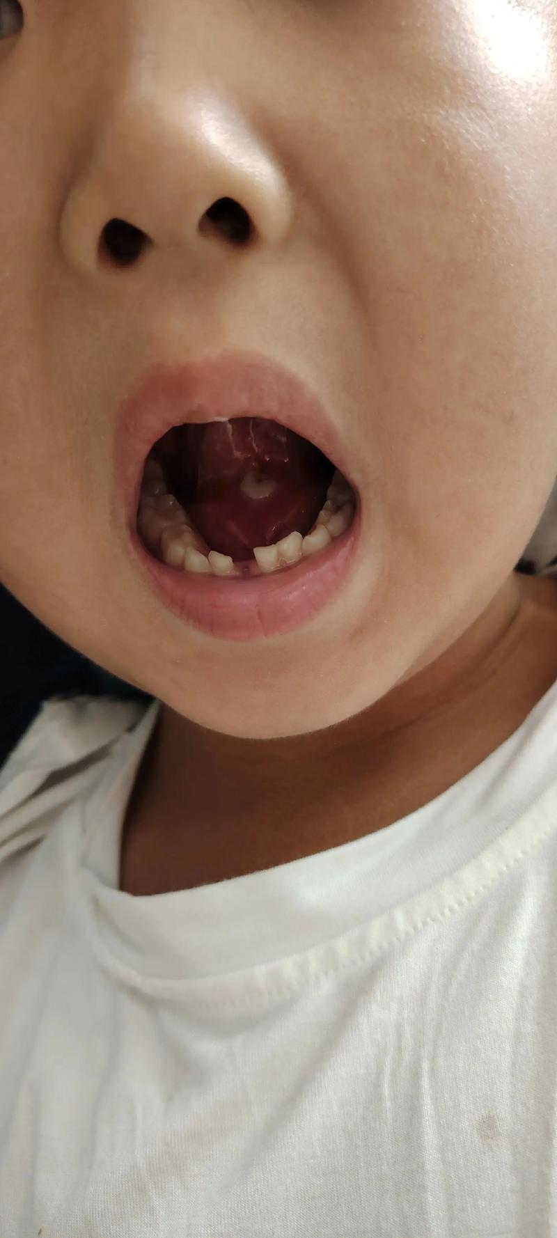 宝宝口腔溃疡怎么办?3个小妙招缓解疼痛?