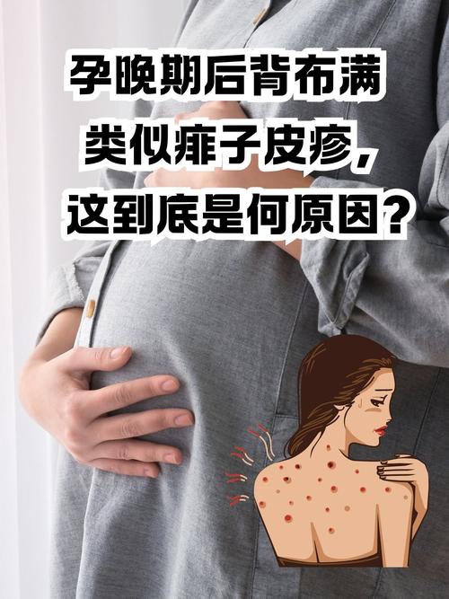 孕期皮肤干燥起皮,该如何缓解?
