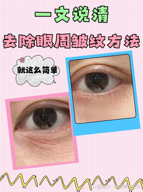 眼睛皱纹多、皮肤松弛,怎么改善?