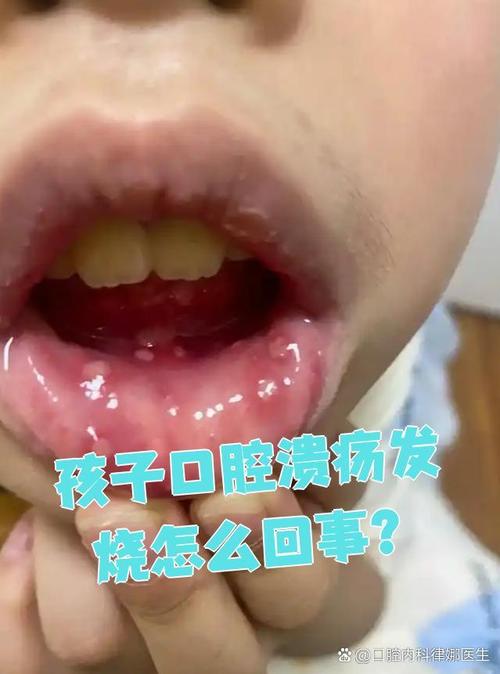 妈妈口腔溃疡会传染给宝宝吗?