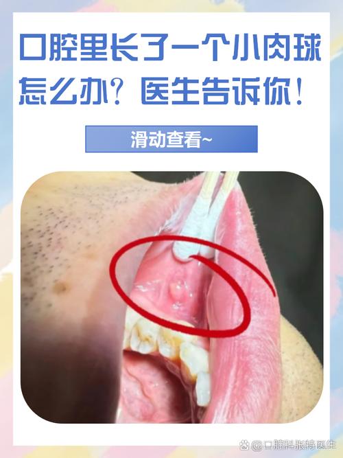 口腔内侧肉疙瘩是什么?要紧吗?
