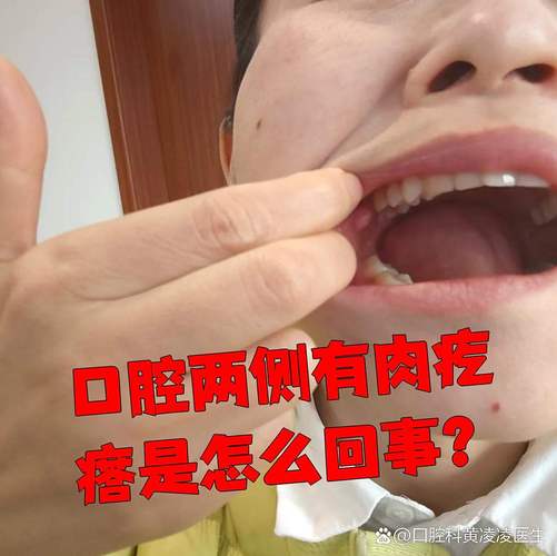 口腔内侧肉疙瘩是什么?要紧吗?