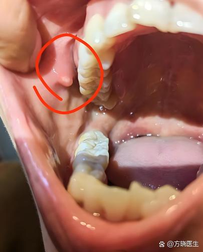 口腔内侧肉疙瘩是什么?要紧吗?