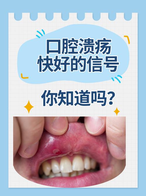 口腔溃疡中医西医怎么选?
