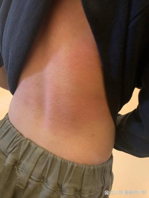 皮肤火辣辣疼却无症状,是何原因?