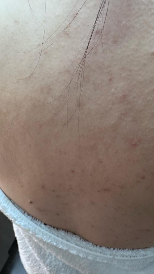 皮肤火辣辣疼却无症状,是何原因?