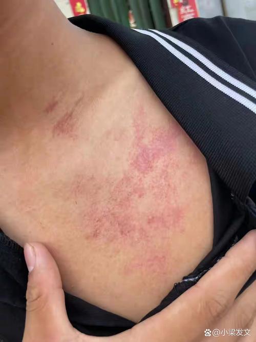 皮肤火辣辣疼却无症状,是何原因?