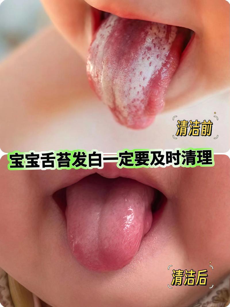 新生儿需清洁口腔舌苔吗?
