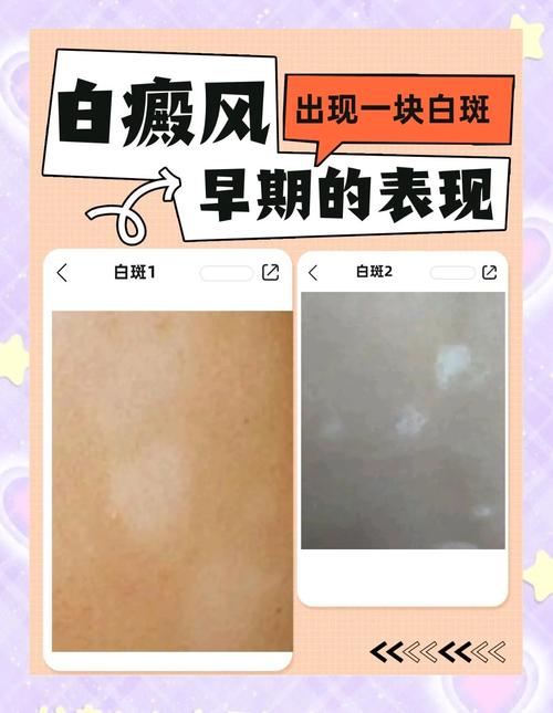 皮肤发白一块一块是啥病?