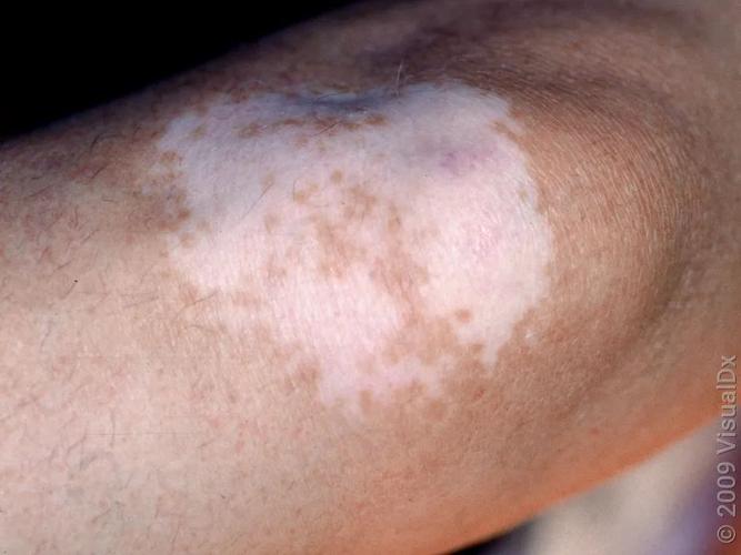 皮肤发白一块一块是啥病?