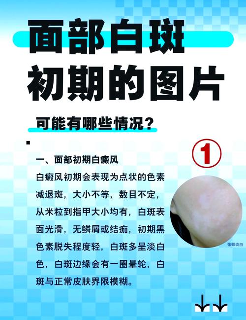 皮肤发白一块一块是啥病?