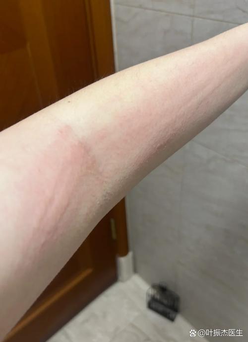 皮肤一抓就起红印是过敏还是其他问题?