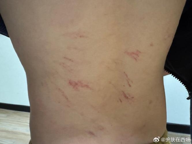 皮肤一抓就起红印是过敏还是其他问题?